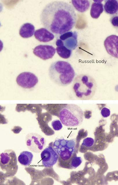 Russell body, Mott cell, Dutcher body